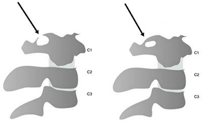 Assessments of Prevalence of Ponticulus Posticus, Atlas Posterior Arch Deficiency, Sella Turcica Bridging, Maxillary Canine Impaction, and Associations Among Them in 500 CBCTs of Italian Orthodontic Patients